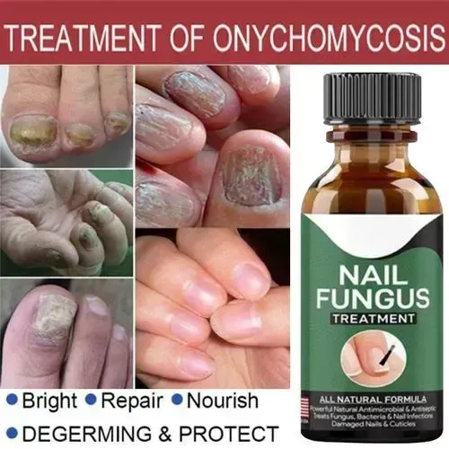 Fast Nail Fungus Treatment Serum - Image 2